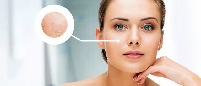 Cách ngăn ngừa và trị mụn cho da khô hiệu quả đến không ngờ