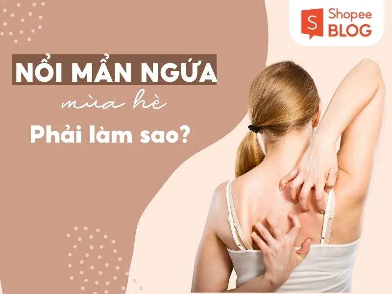 Mẩn ngứa mùa hè – nỗi lo không của riêng ai