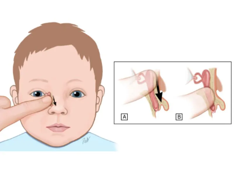 Nguyên nhân đổ ghèn & cách làm sạch ghèn mắt cho trẻ sơ sinh