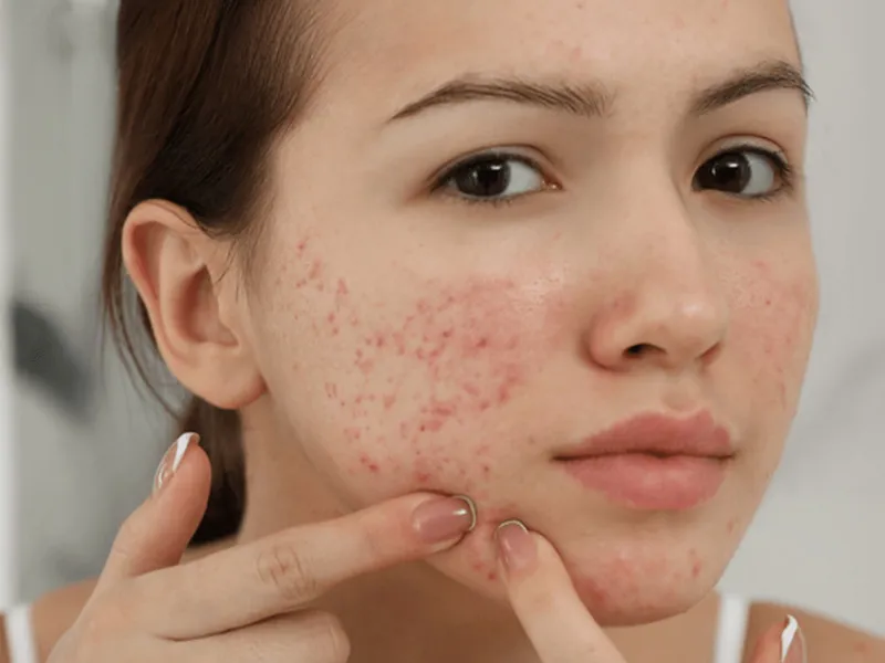 Quy trình skincare cho da dầu mụn mịn màng và khỏe mạnh hơn