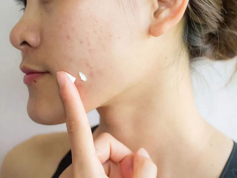 Quy trình skincare cho da dầu mụn mịn màng và khỏe mạnh hơn