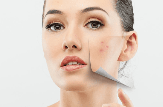 Retinol có trị mụn không? Những lưu ý sử dụng mà bạn cần biết