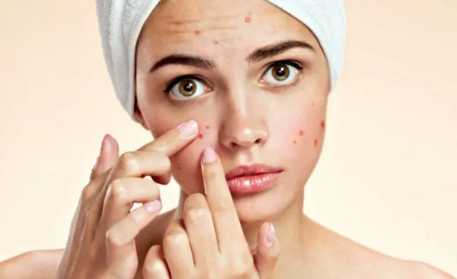 Xà phòng rửa mặt trị mụn – Xu hướng mới cho việc chăm sóc da